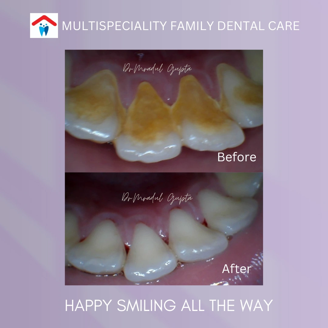 The Importance of Dental Scaling and Polishing: A Comprehensive Guide