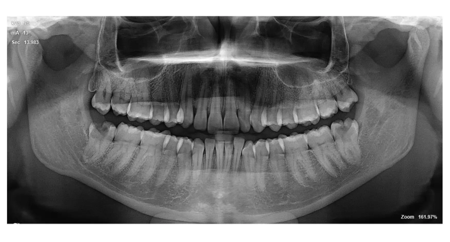 Wisdom Tooth Removal : What You Should Expect!!